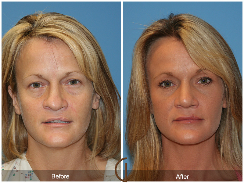 Female Rhinoplasty Before & After Image