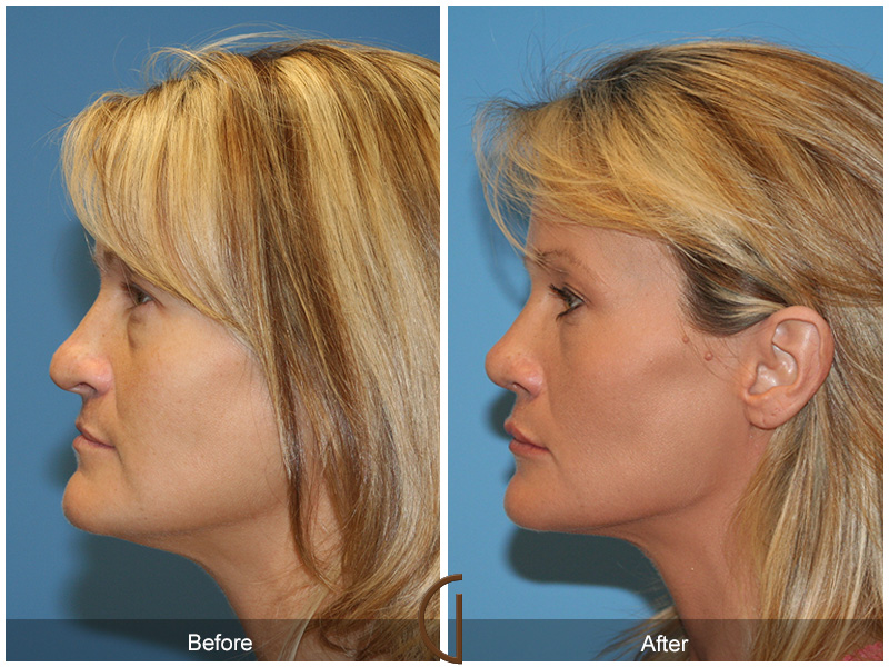 Female Rhinoplasty Before & After Image