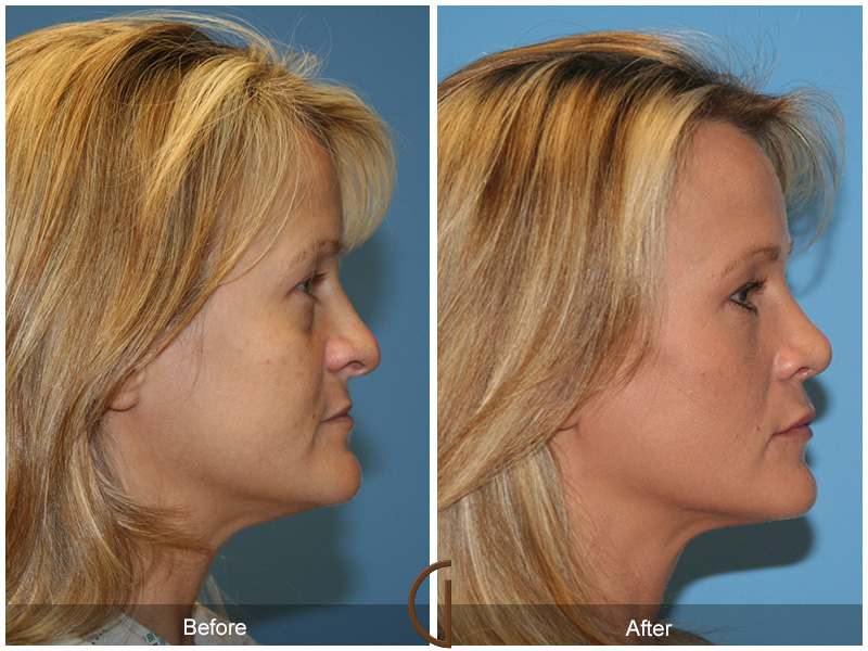 Female Rhinoplasty Before & After Image