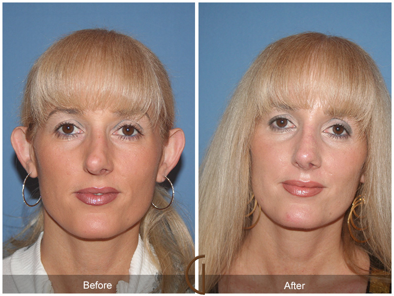 Female Rhinoplasty Before & After Image