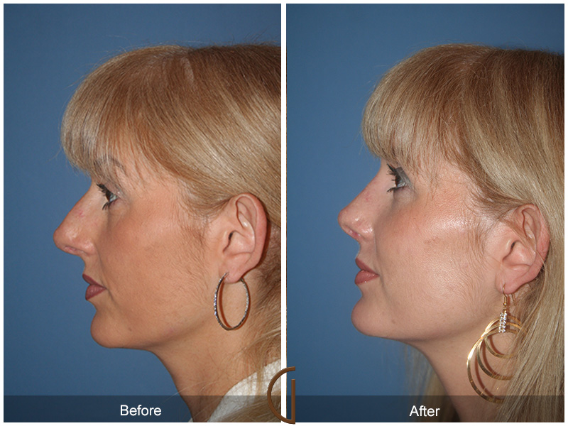 Female Rhinoplasty Before & After Image