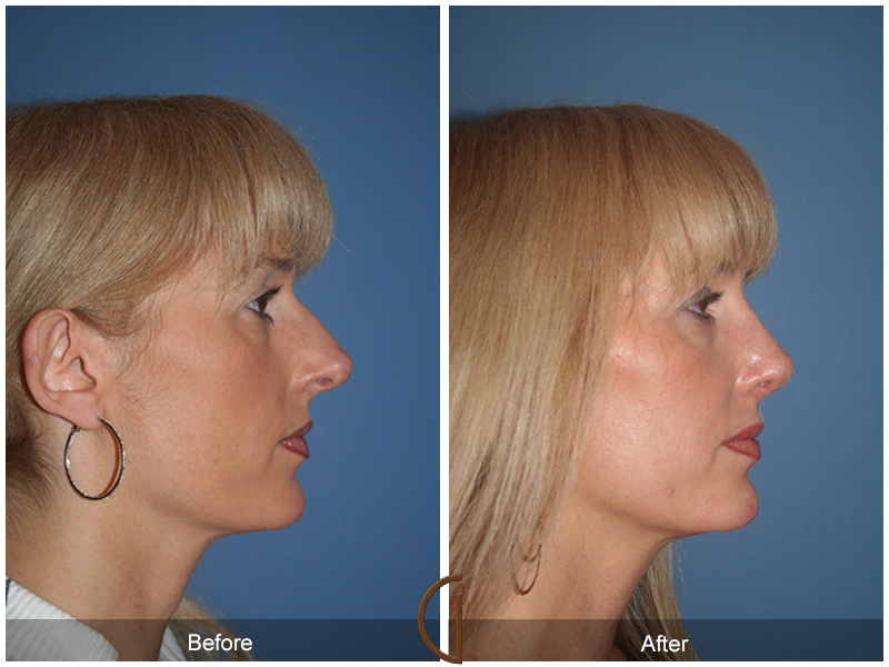 Female Rhinoplasty Before & After Image