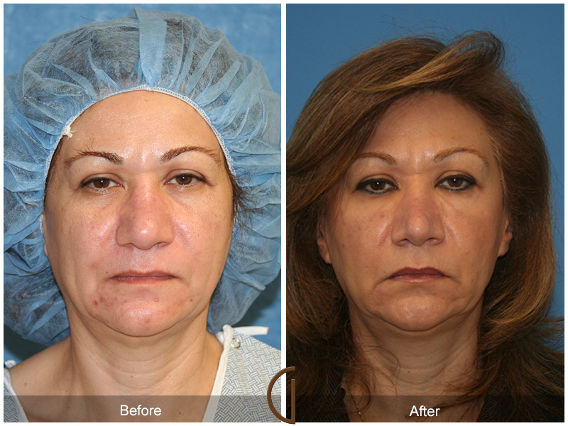 Female Rhinoplasty Before & After Image