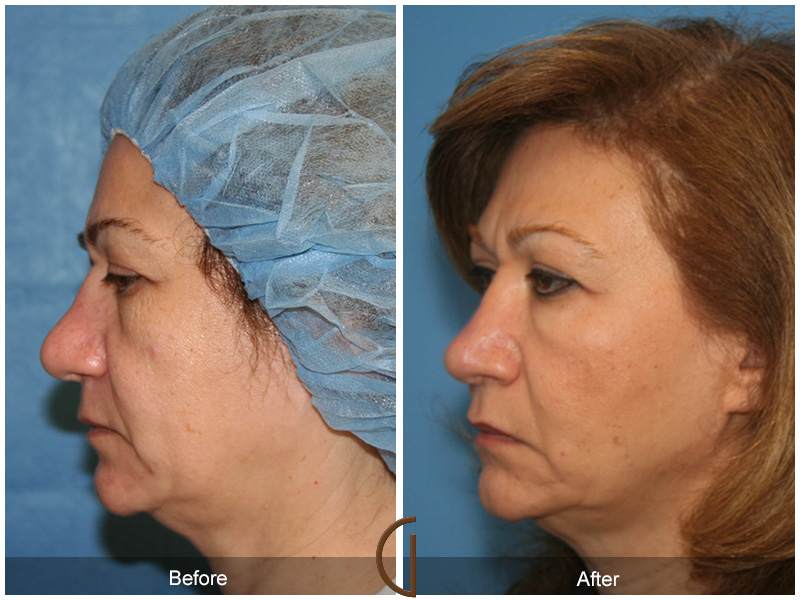 Female Rhinoplasty Before & After Image