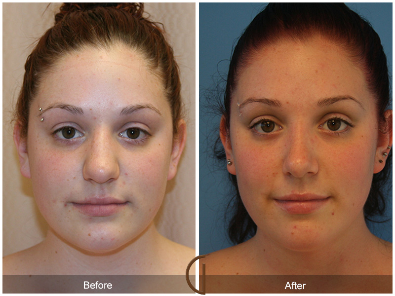 Female Rhinoplasty Before & After Image