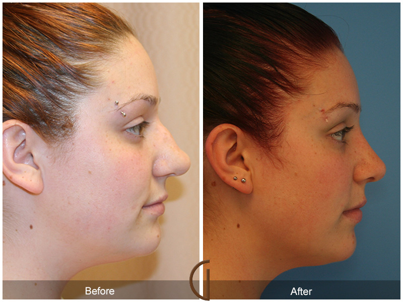 Female Rhinoplasty Before & After Image