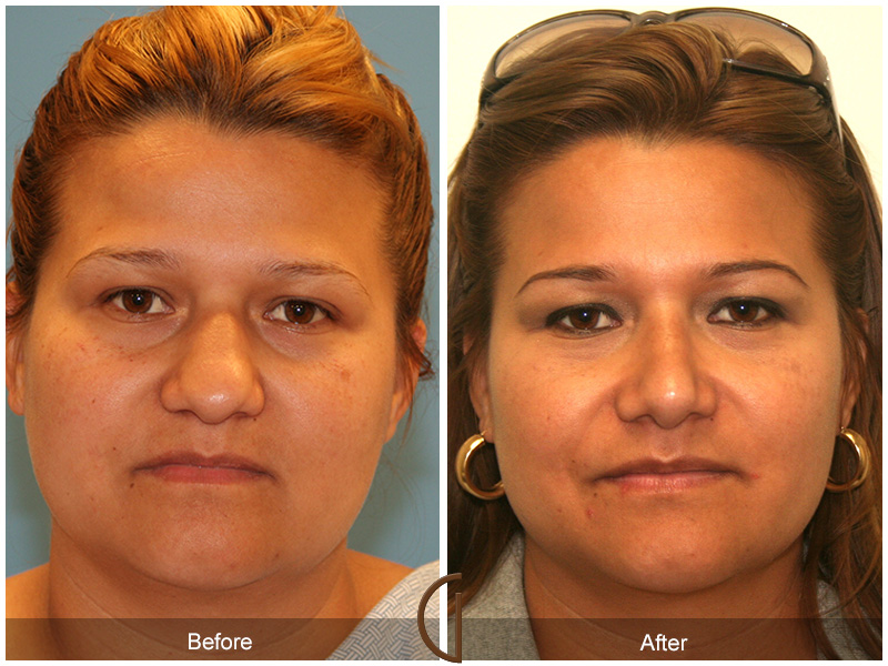 Female Rhinoplasty Before & After Image