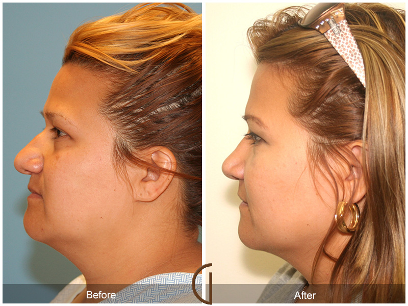 Female Rhinoplasty Before & After Image