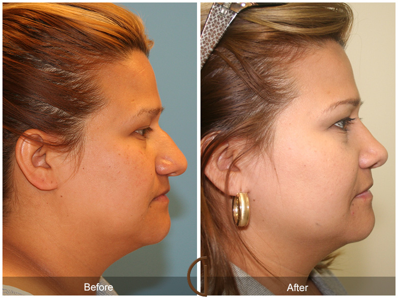 Female Rhinoplasty Before & After Image