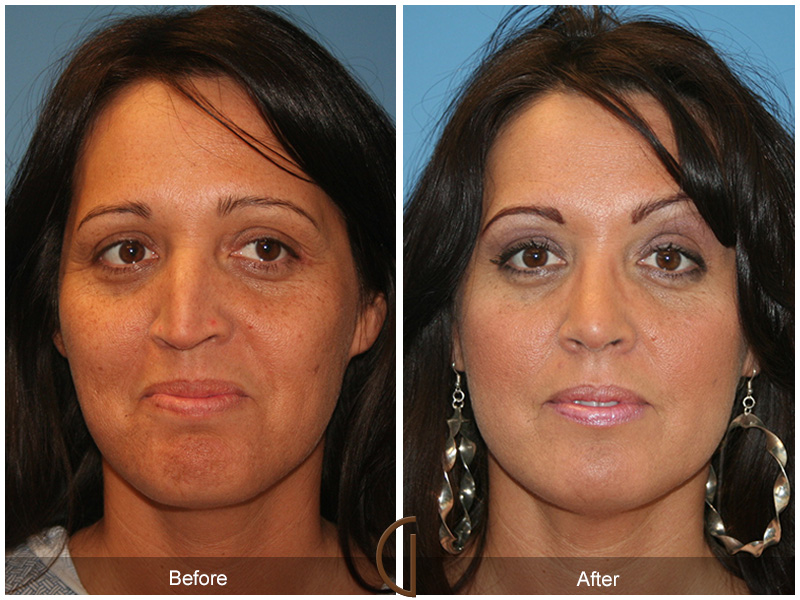 Female Rhinoplasty Before & After Image