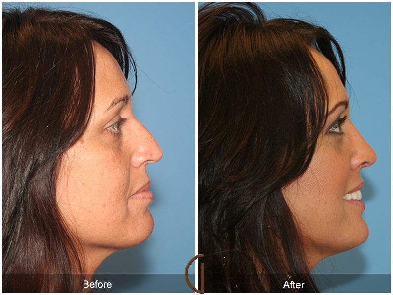 Female Rhinoplasty Before & After Image