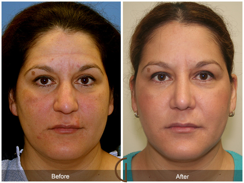 Female Rhinoplasty Before & After Image