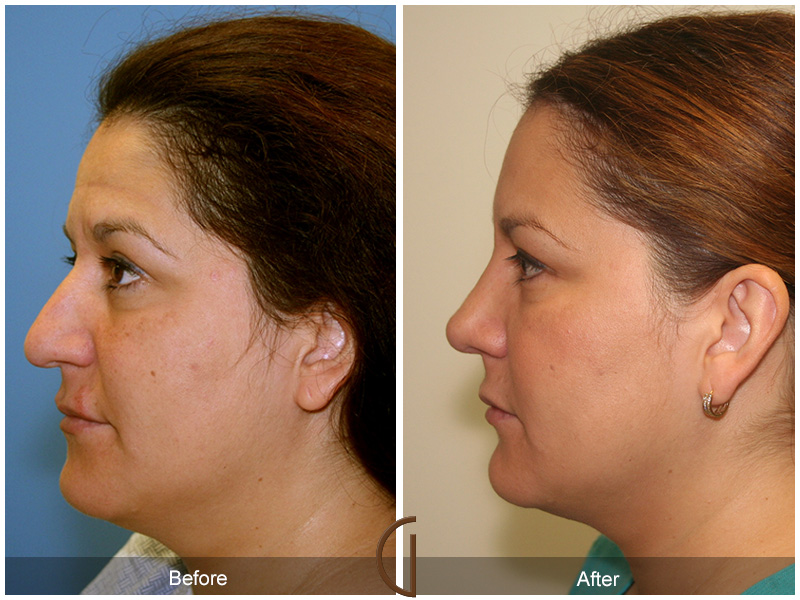 Female Rhinoplasty Before & After Image