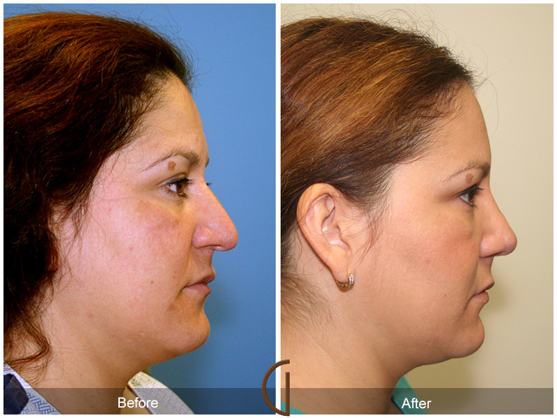 Female Rhinoplasty Before & After Image