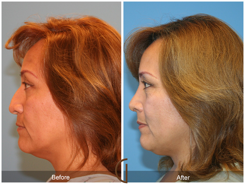 Female Rhinoplasty Before & After Image