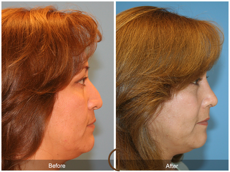 Female Rhinoplasty Before & After Image