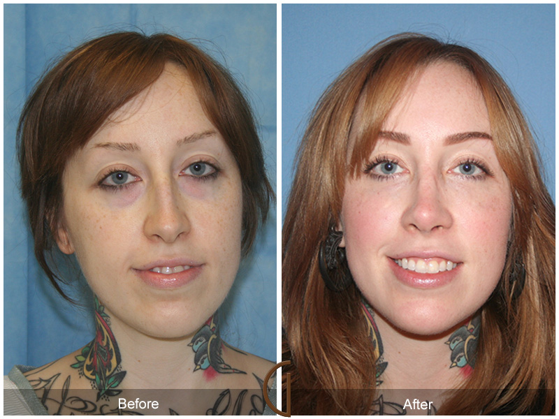 Female Rhinoplasty Before & After Image