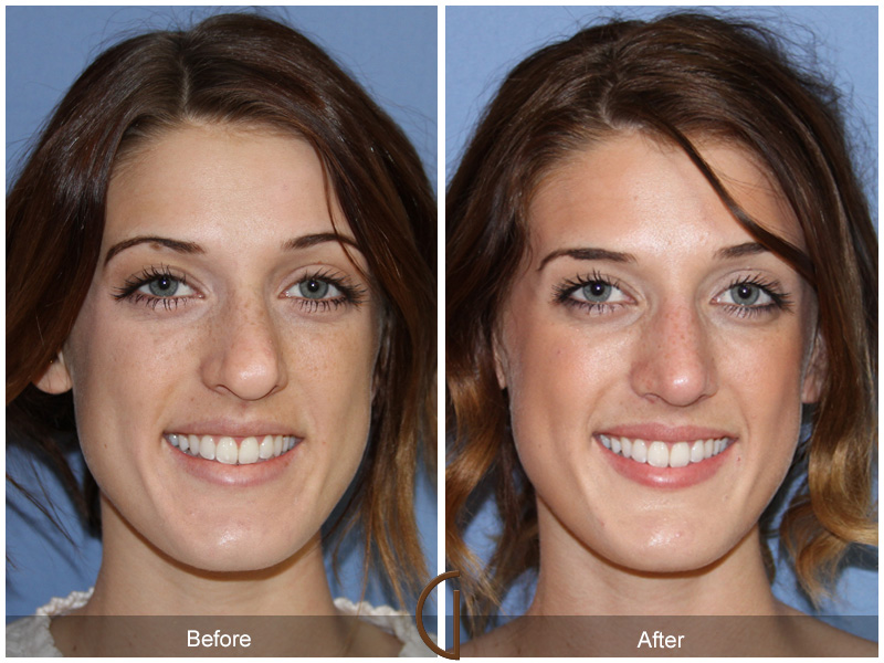 Female Rhinoplasty Before & After Image