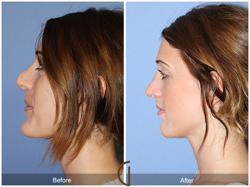 Female Rhinoplasty Before & After Image