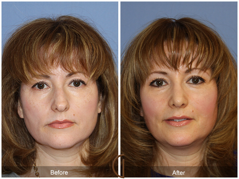 Female Rhinoplasty Before & After Image