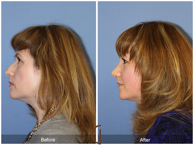 Female Rhinoplasty Before & After Image