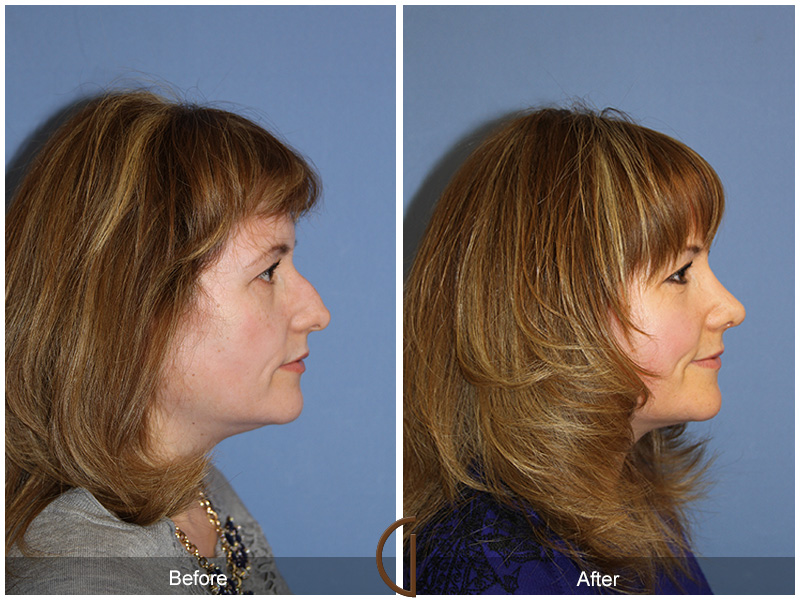 Female Rhinoplasty Before & After Image