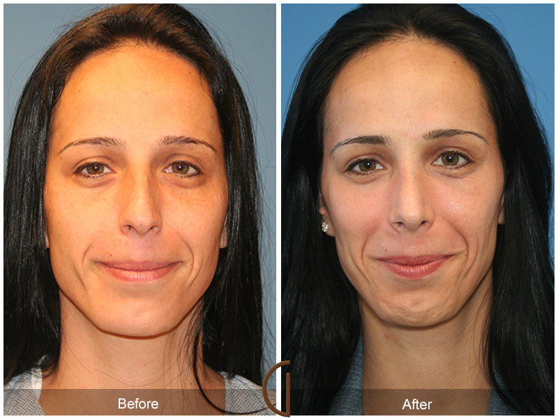 Female Rhinoplasty Before & After Image