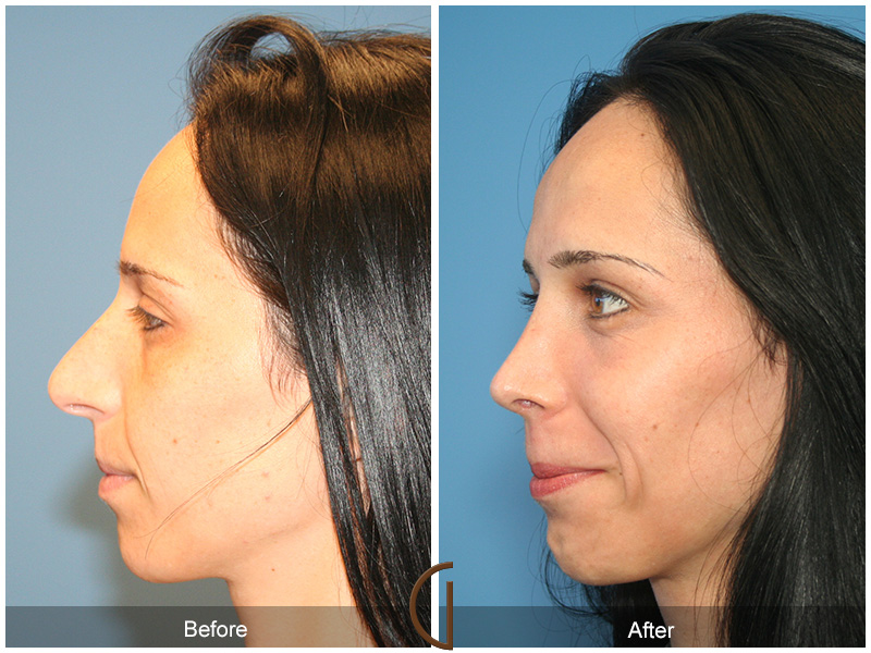 Female Rhinoplasty Before & After Image