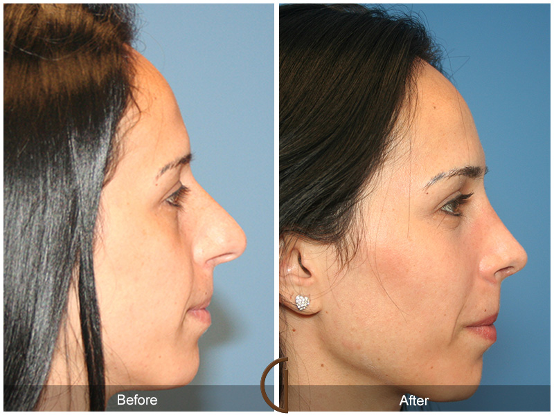 Female Rhinoplasty Before & After Image