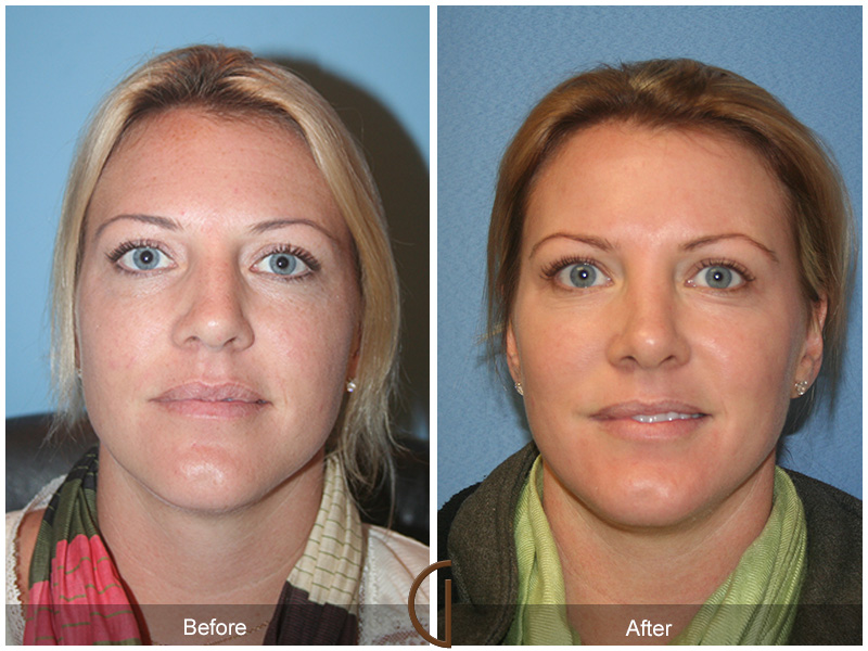 Female Rhinoplasty Before & After Image