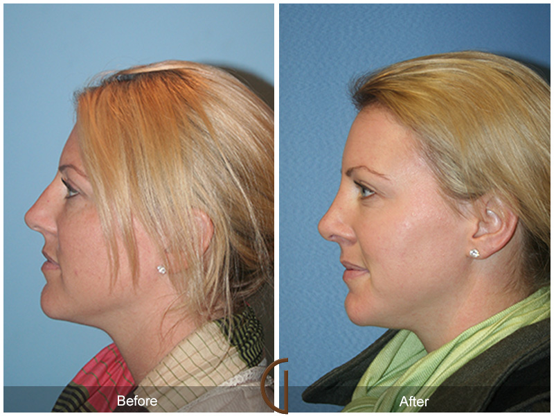 Female Rhinoplasty Before & After Image