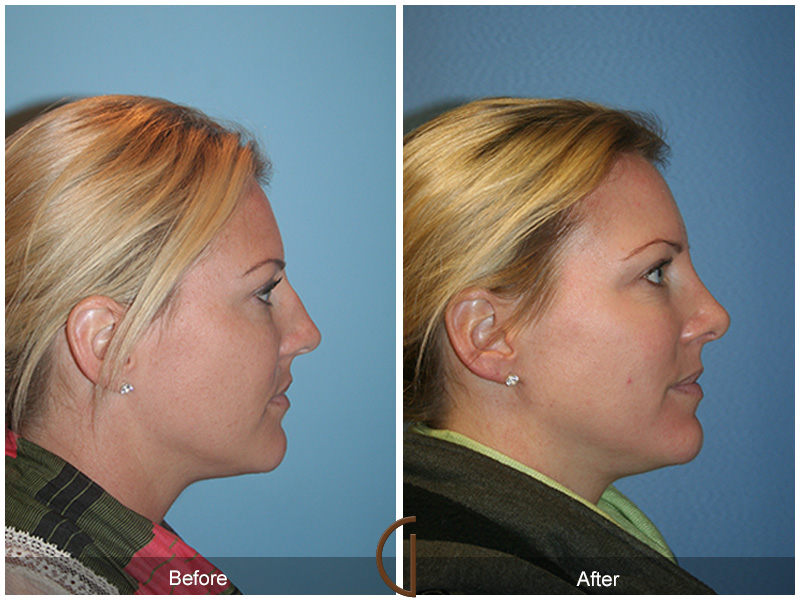 Female Rhinoplasty Before & After Image