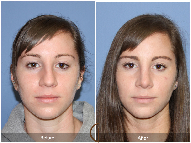 Female Rhinoplasty Before & After Image