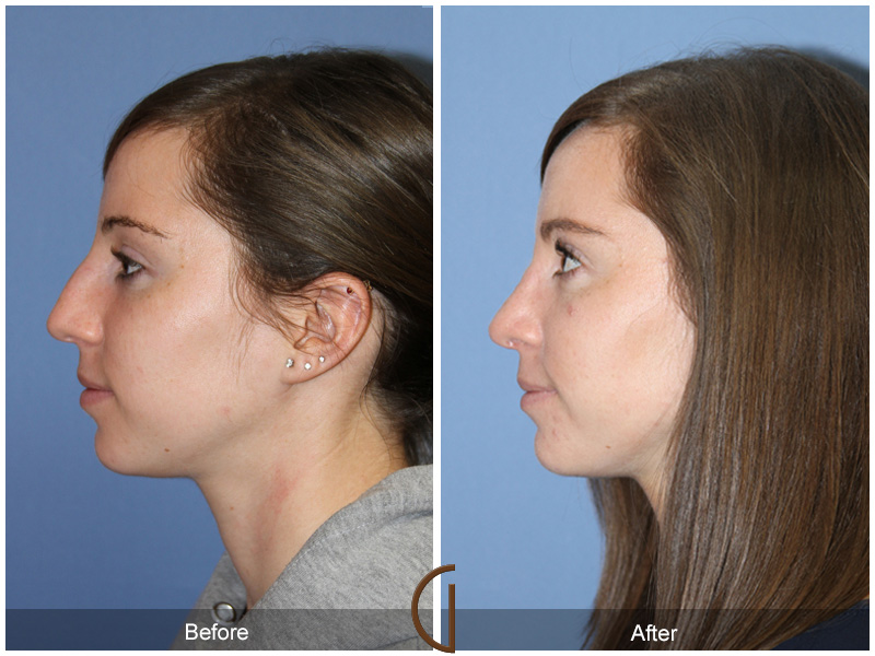 Female Rhinoplasty Before & After Image