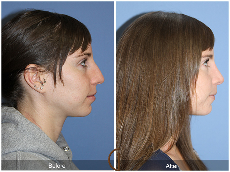 Female Rhinoplasty Before & After Image