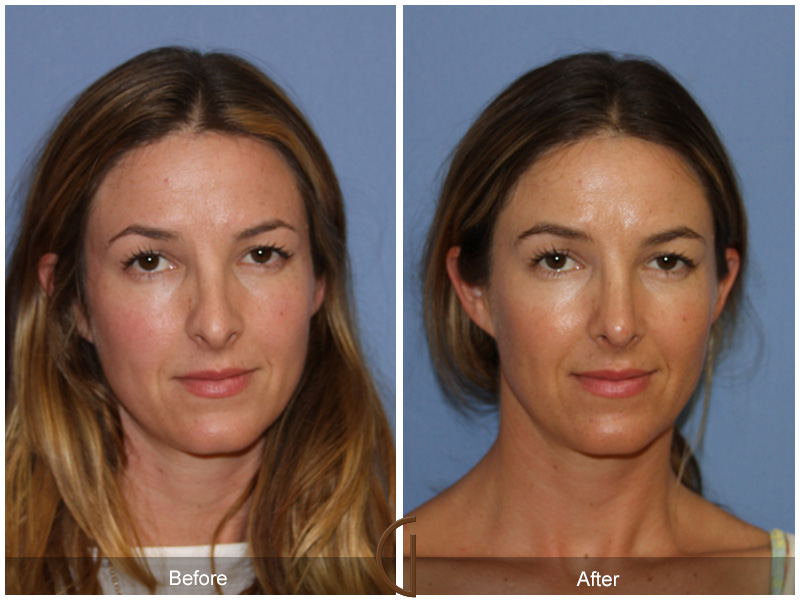 Female Rhinoplasty Before & After Image