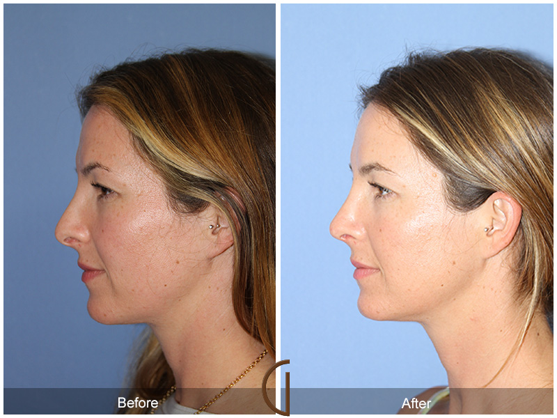 Female Rhinoplasty Before & After Image