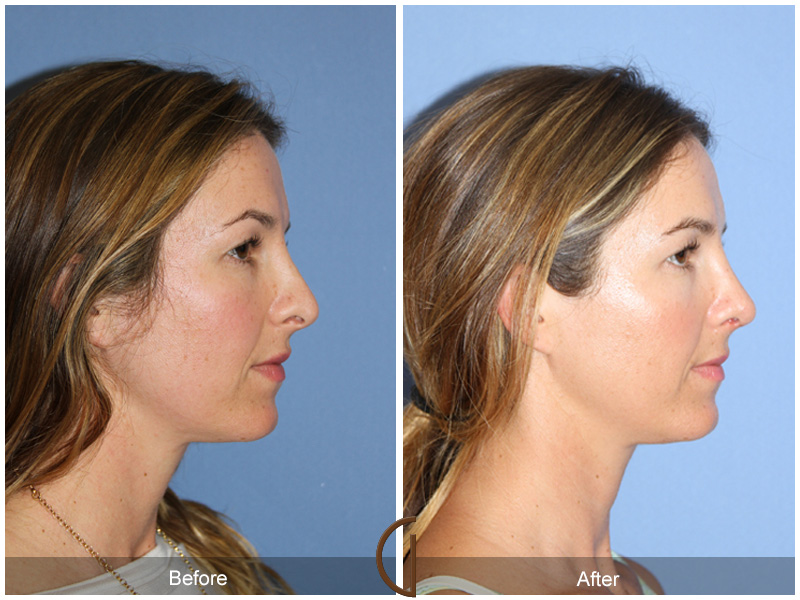 Female Rhinoplasty Before & After Image