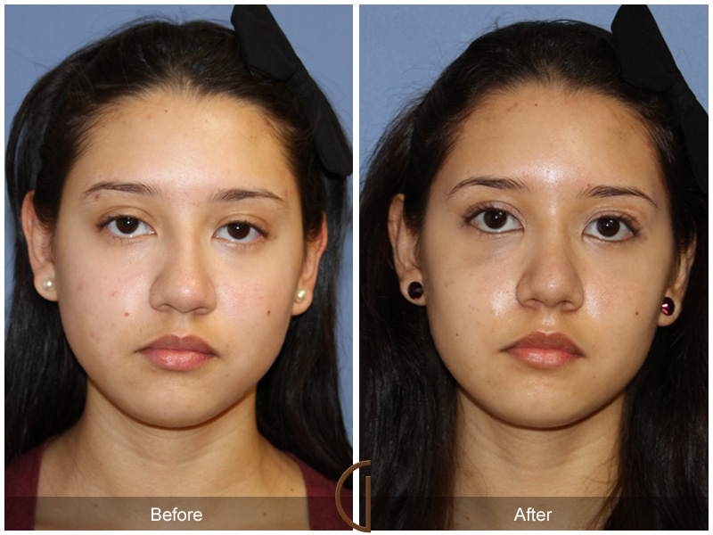 Female Rhinoplasty Before & After Image