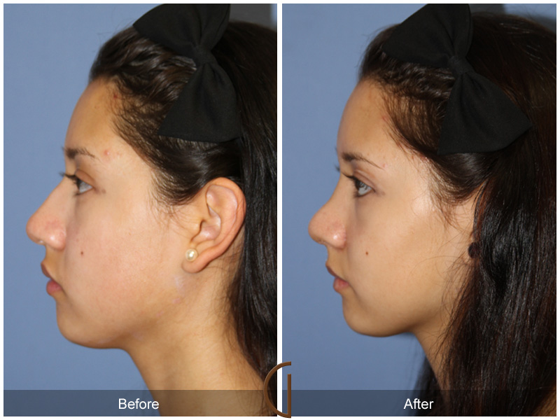 Female Rhinoplasty Before & After Image