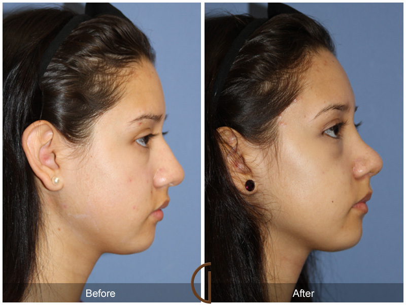 Female Rhinoplasty Before & After Image