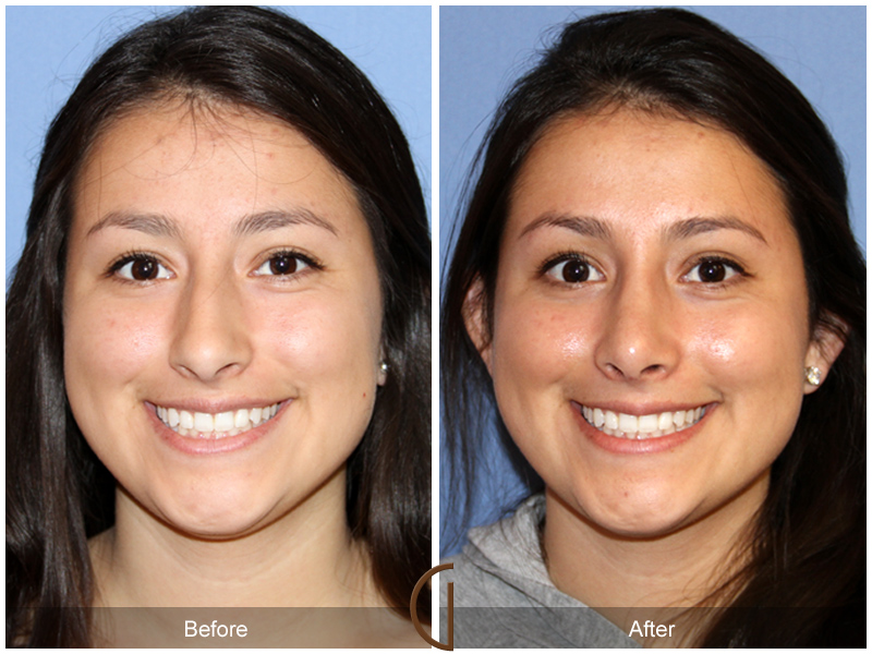 Female Rhinoplasty Before & After Image