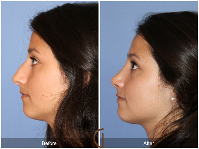 Female Rhinoplasty Before & After Image