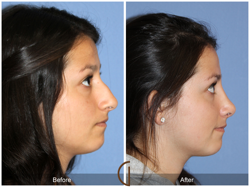 Female Rhinoplasty Before & After Image