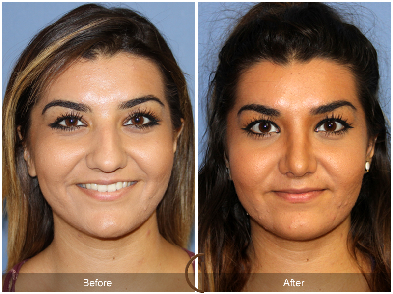 Female Rhinoplasty Before & After Image