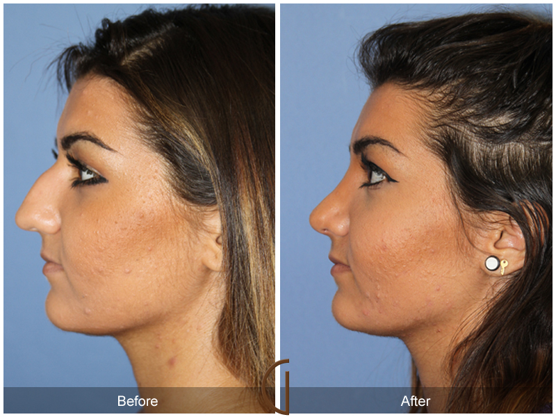 Female Rhinoplasty Before & After Image