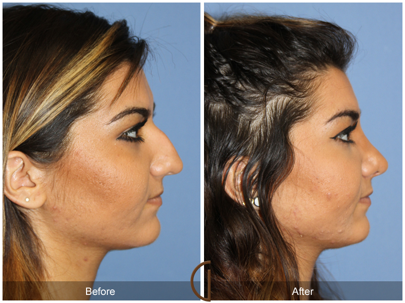 Female Rhinoplasty Before & After Image