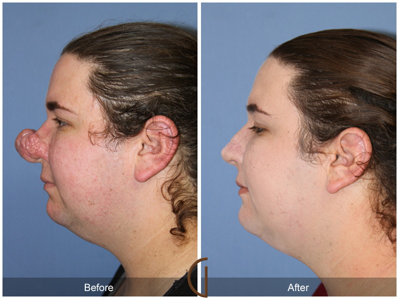 Female Rhinoplasty Before & After Image