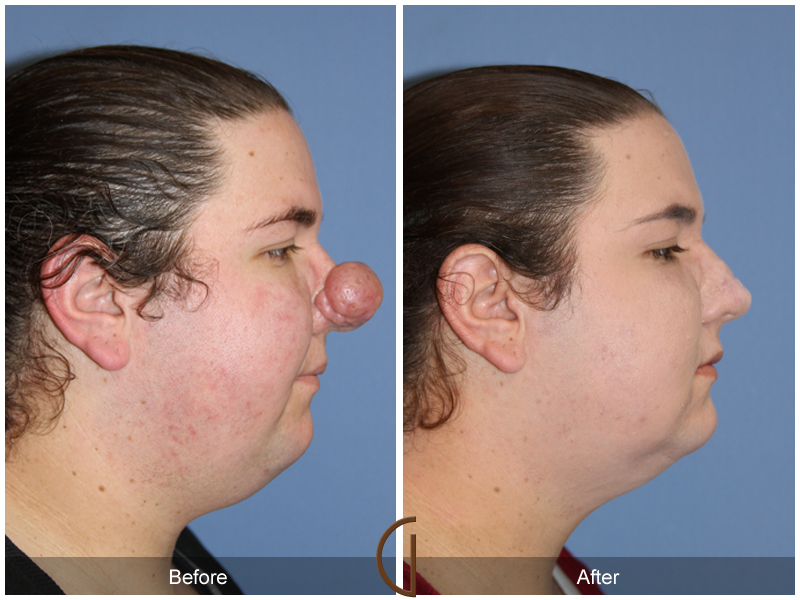 Female Rhinoplasty Before & After Image