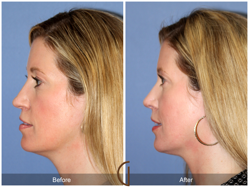 Female Rhinoplasty Before & After Image